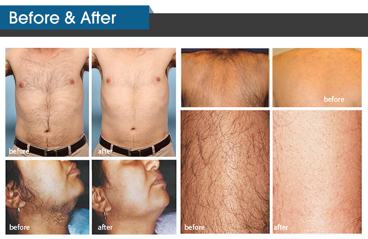 Tecnología de depilación láser