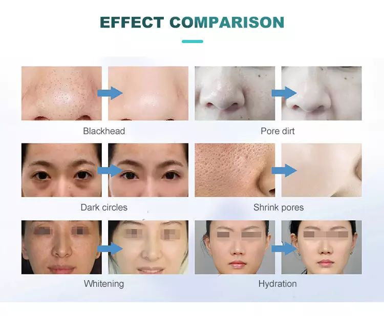 Máquina de burbujas de dermoabrasión